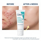 CeraVe Acne Foaming Cream Cleanser 150ml – 4% Benzoyl Peroxide Face Wash for Acne